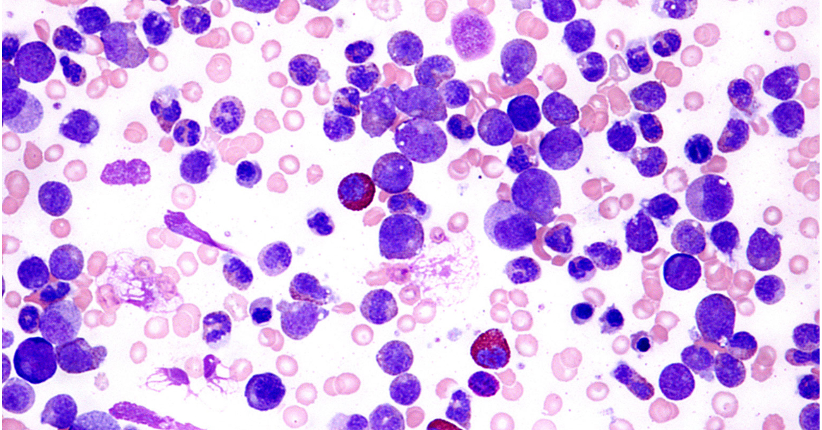 Chronic myeloid leukemia - 1200