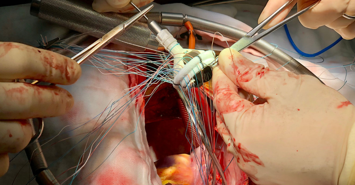 Mitral Valve Replacement - 1200