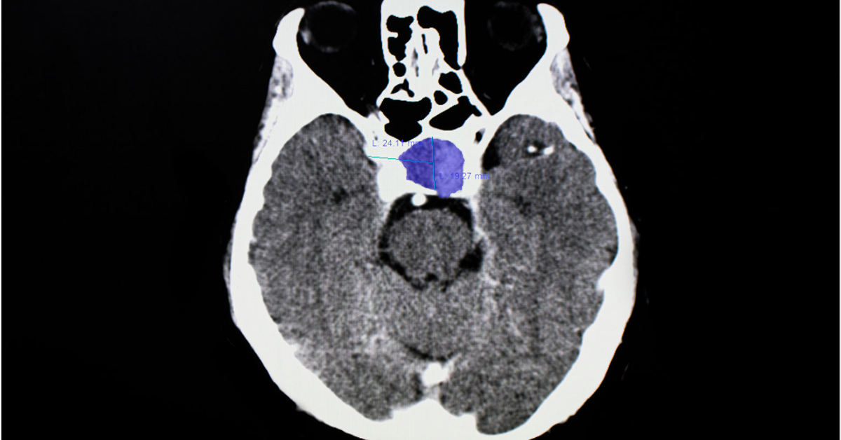 Pituitary Tumor