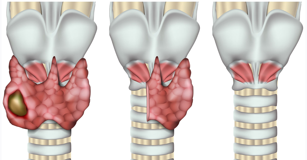 Cara hinchada tiroides