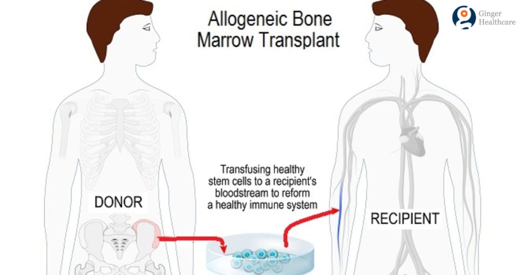 Bone Marrow Transplant: What It Is, When And How It Is Done