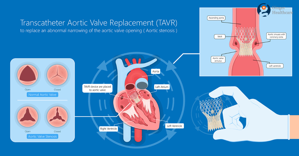 Late Complications Of Aortic Valve Replacement