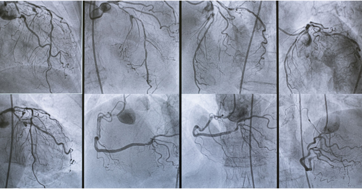 Coronary Angiography: Procedure, Side-Effects & FAQs