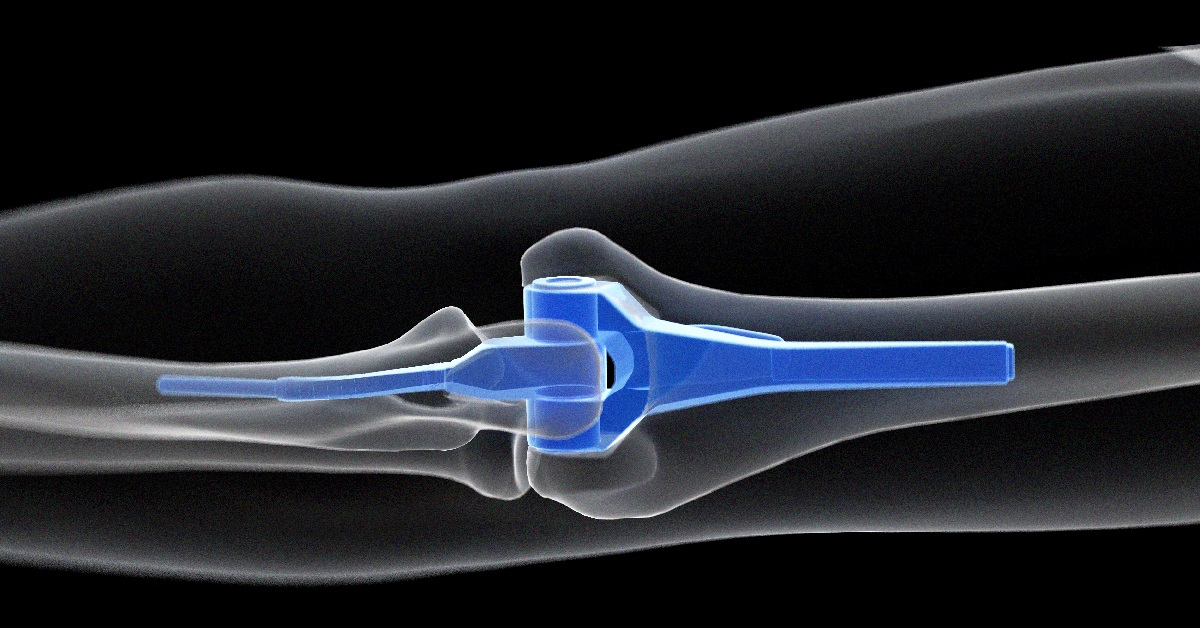 Elbow Replacement Image