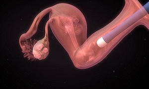 IVF Follicle aspiration - Egg Pick up Image
