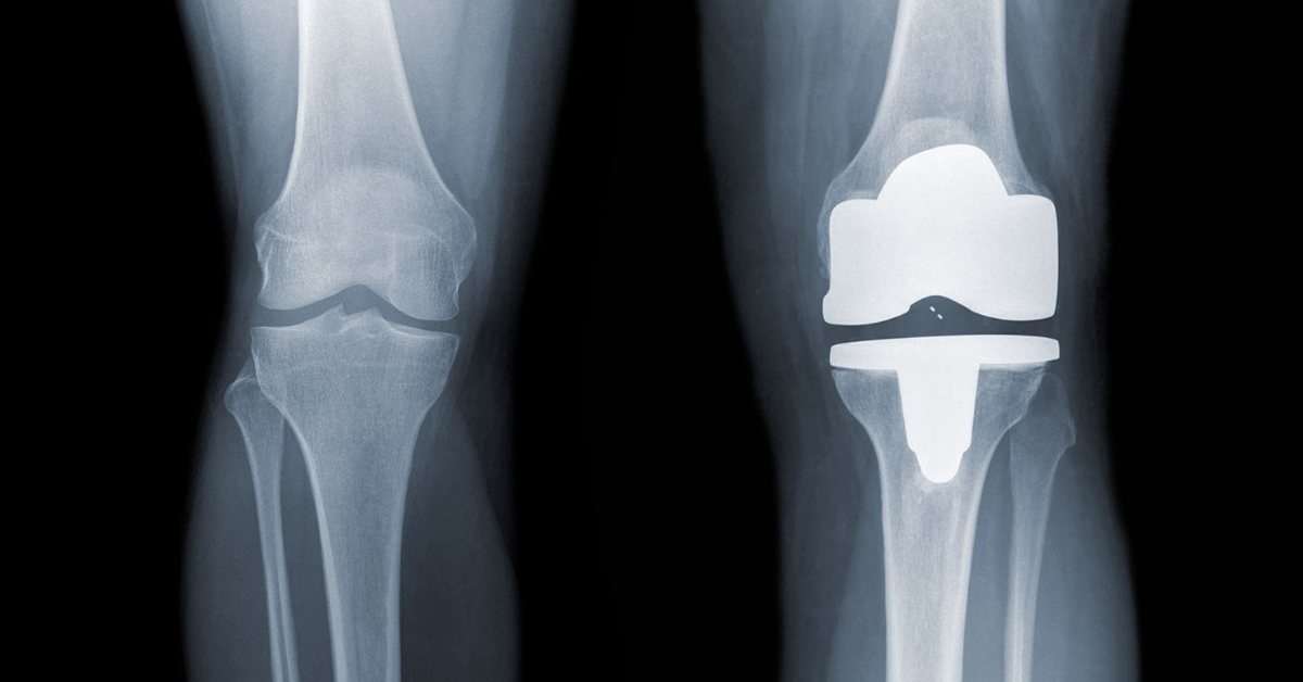 Knee Replacement - 1200