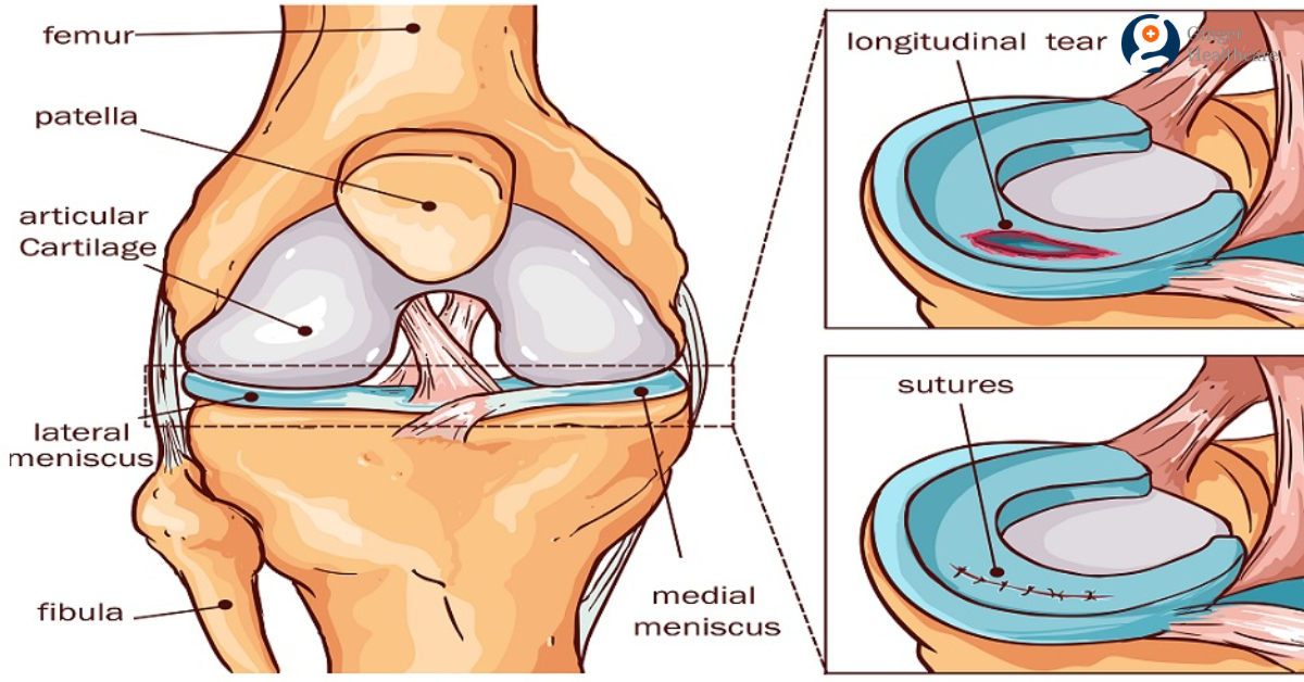 Meniscus Tear Repair Meniscus Tear Causes Symptoms Repair Procedure