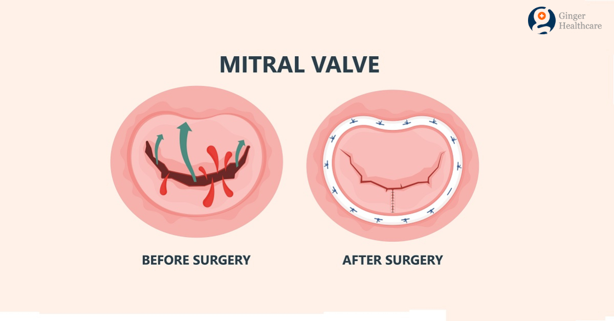 mitral-valve-replacement-symptoms-diagnosis-procedure-explained