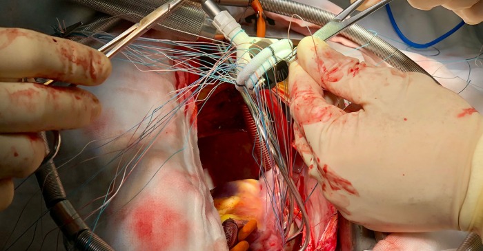 Mitral Valve Replacement: Indications, Purpose, Preparation, Test to be