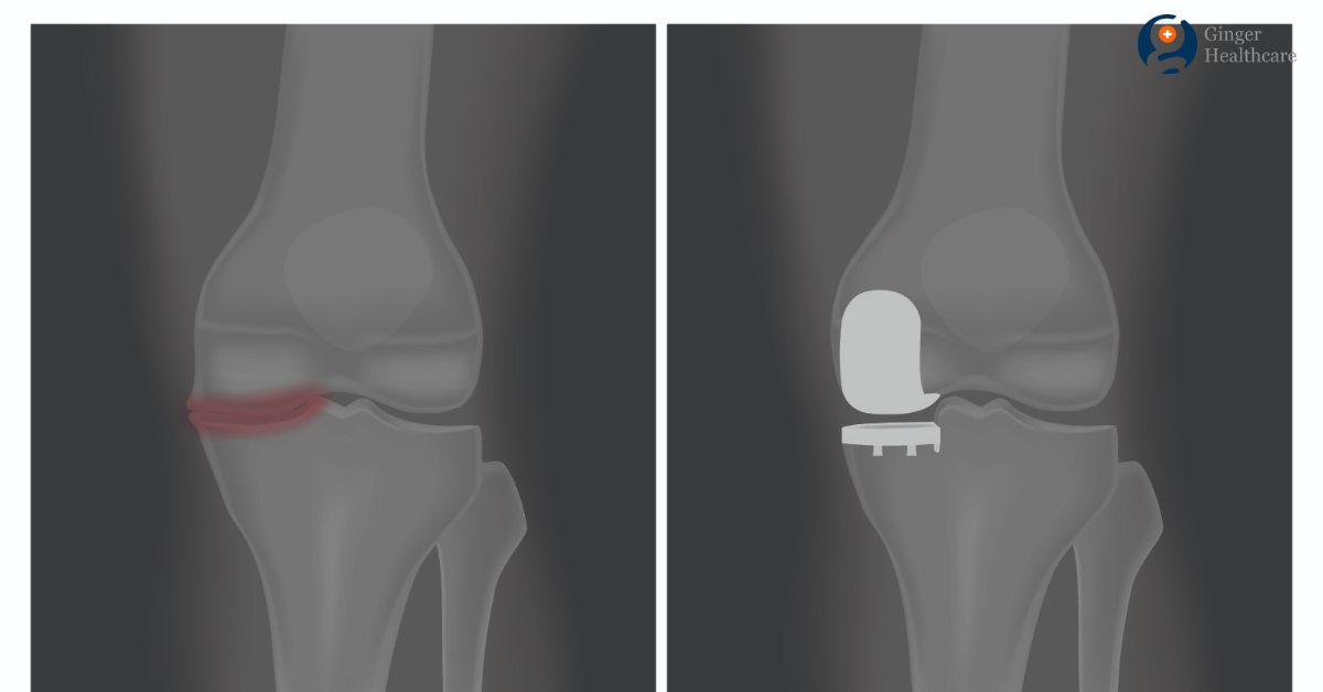 Partial Knee Replacement Purpose, Preparation, Procedure