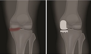 Partial knee Replacement Image 2