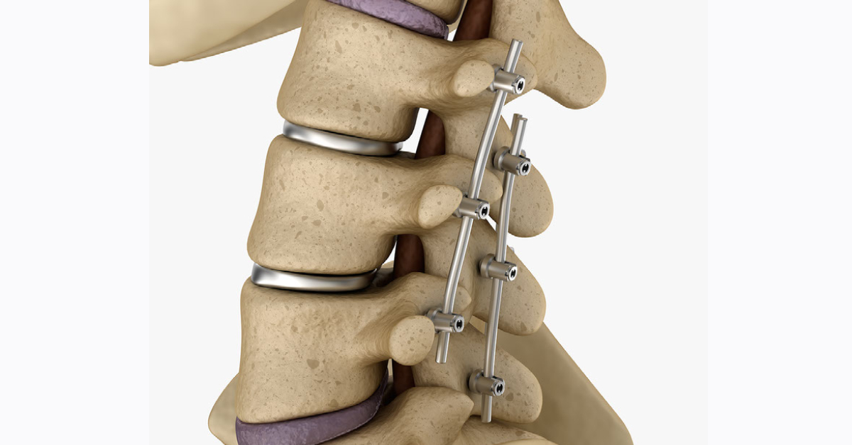 Spinal Decompression & Fusion image