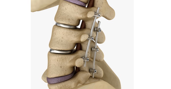 Spinal Decompression & Fusion: Procedure