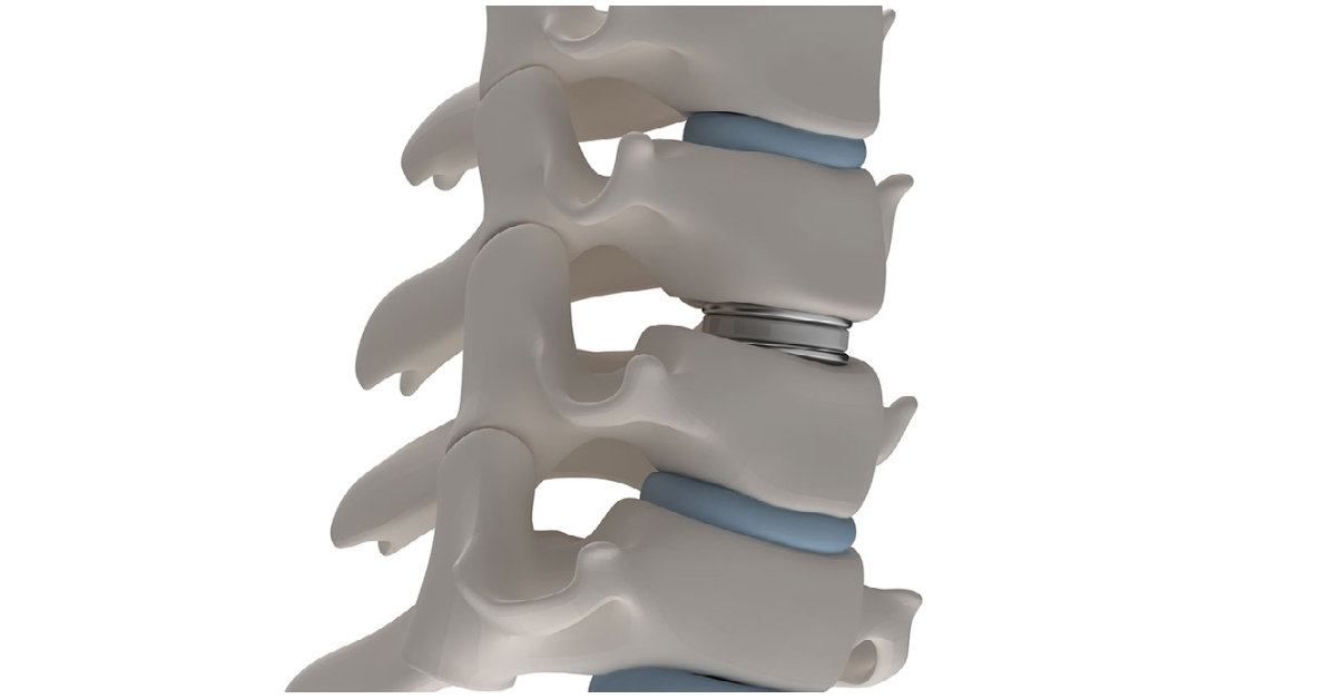 Spinal Disc Replacement - 1200