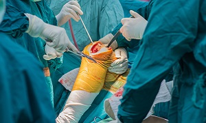 Surgery Knee Replacement Image