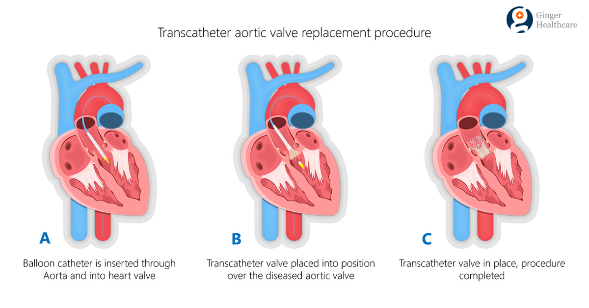 TAVR Procedure: Indications, Diagnosis, Procedure Explained