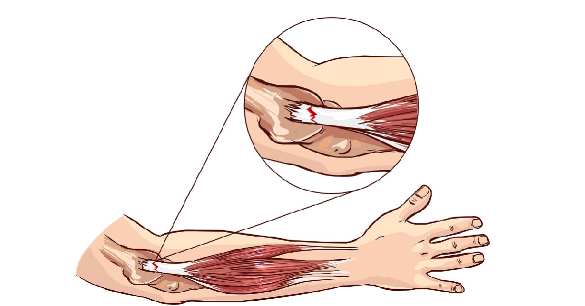 Tennis Elbow Surgery: Surgical Options