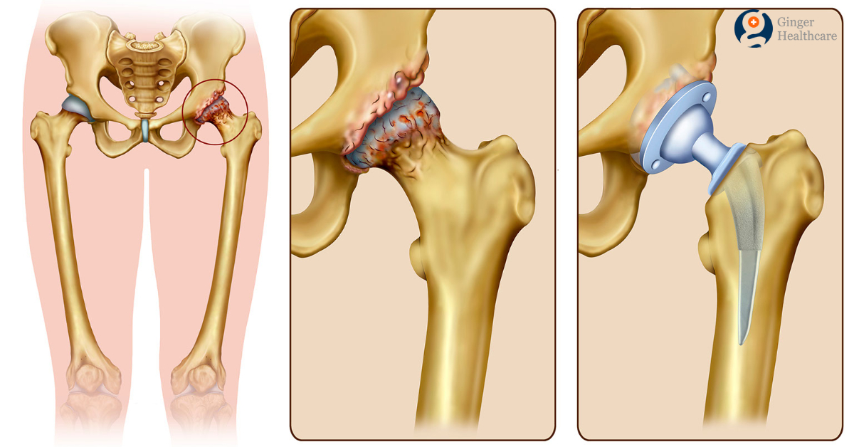 total-hip-replacement-nordahl