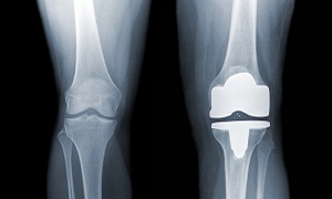 Total knee Replacement Image 1