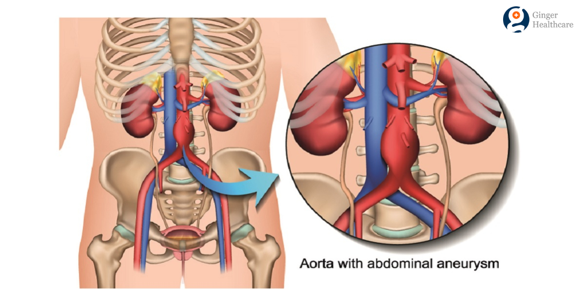 aorta-anatomy-function-branches-location-aorta-problems