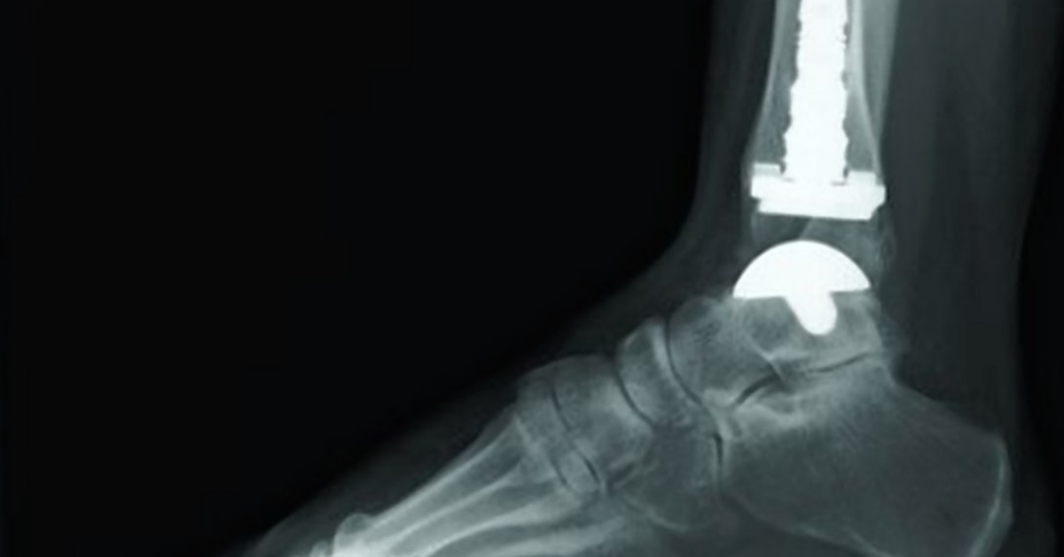 Best Ankle Replacement Doctors & Hospitals in India