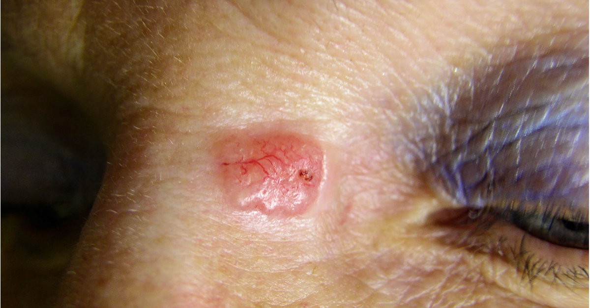 Basal Cell Carcinoma image