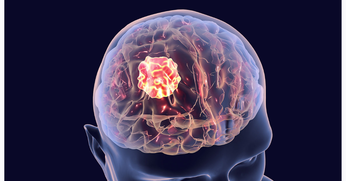 Brain Tumors image