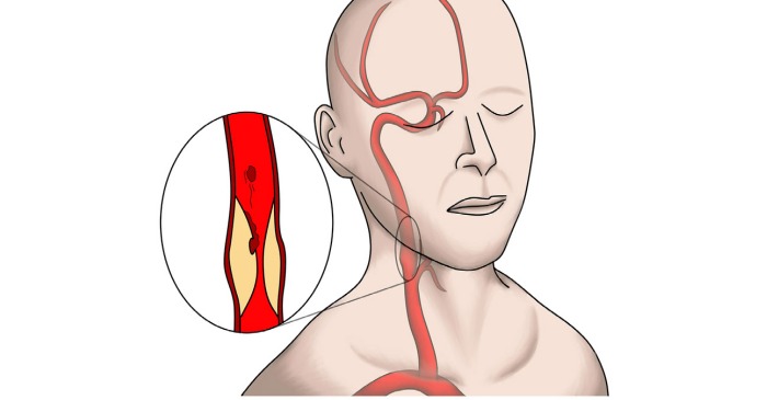 carotid-artery-stenosis-what-it-is-how-it-is-treated