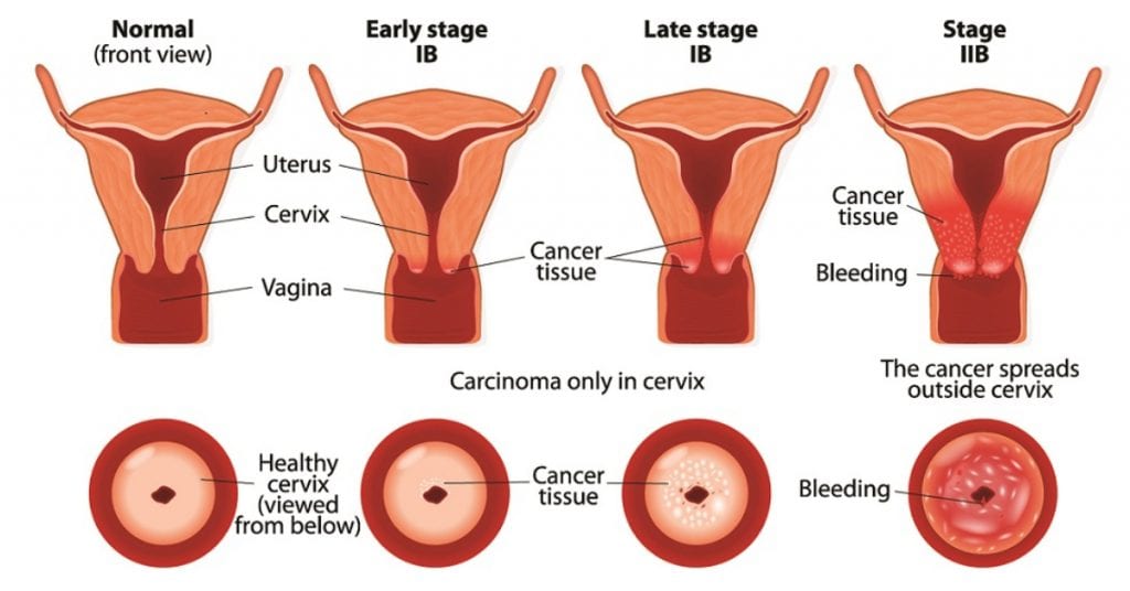 Cervical Cancer Surgery