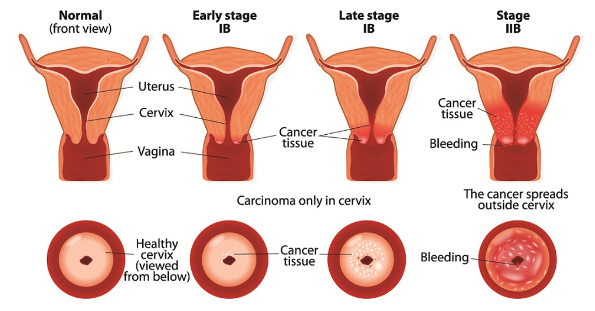 Cervical Cancer - 1200