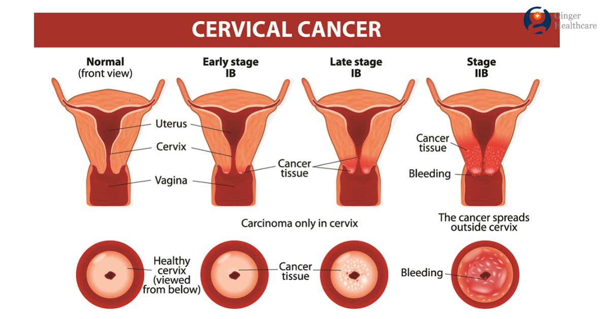 Cervical Cancer Causes Symptoms Stages Diagnosis Treatment Options