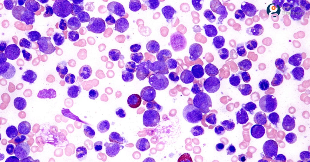 Leukemia: Causes, Symptoms, Diagnosis, Types, Treatment options