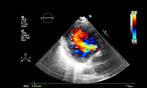 Doppler Echocardiography Image