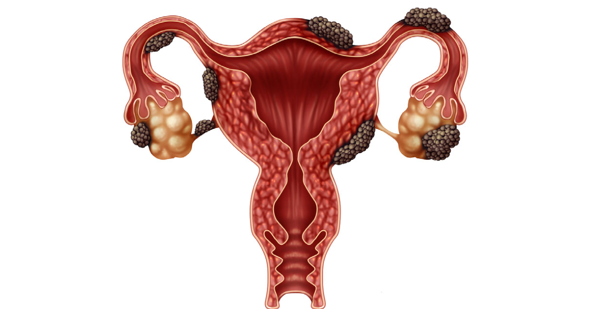 Endometriosis - 1200