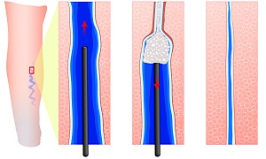 Foam Sclerotherapy Image