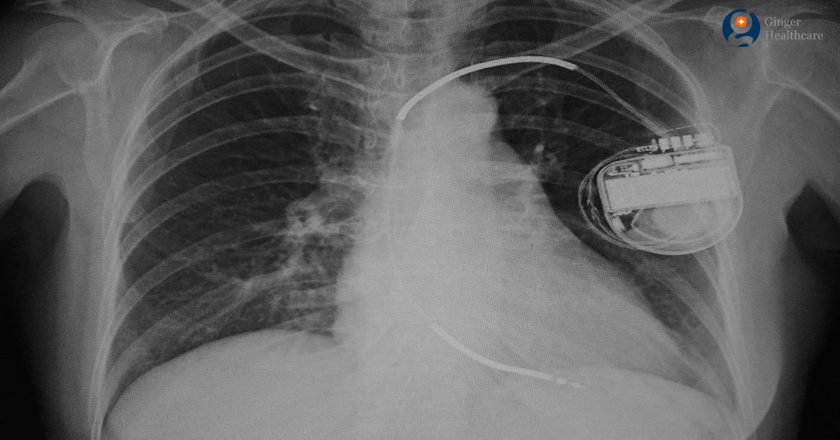 Single chamber icd placement