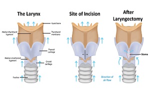 Laryngectomy Image