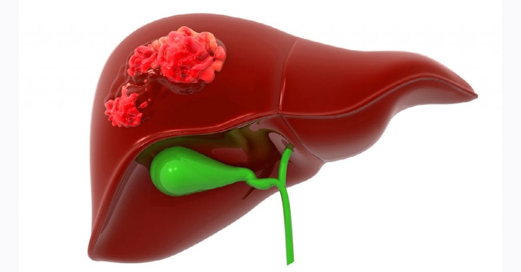 what-are-the-causes-of-liver-cancer-article-block