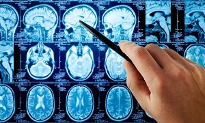 MRI Brain Tumor Image