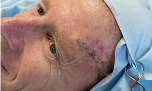 Mohs surgery Image 1