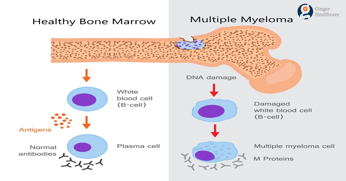 Multiple Myeloma Cancer Net