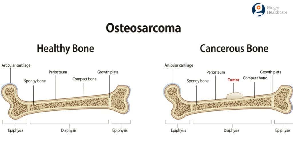 bone-cancer-symptoms-causes-diagnosis-types-treatment-options