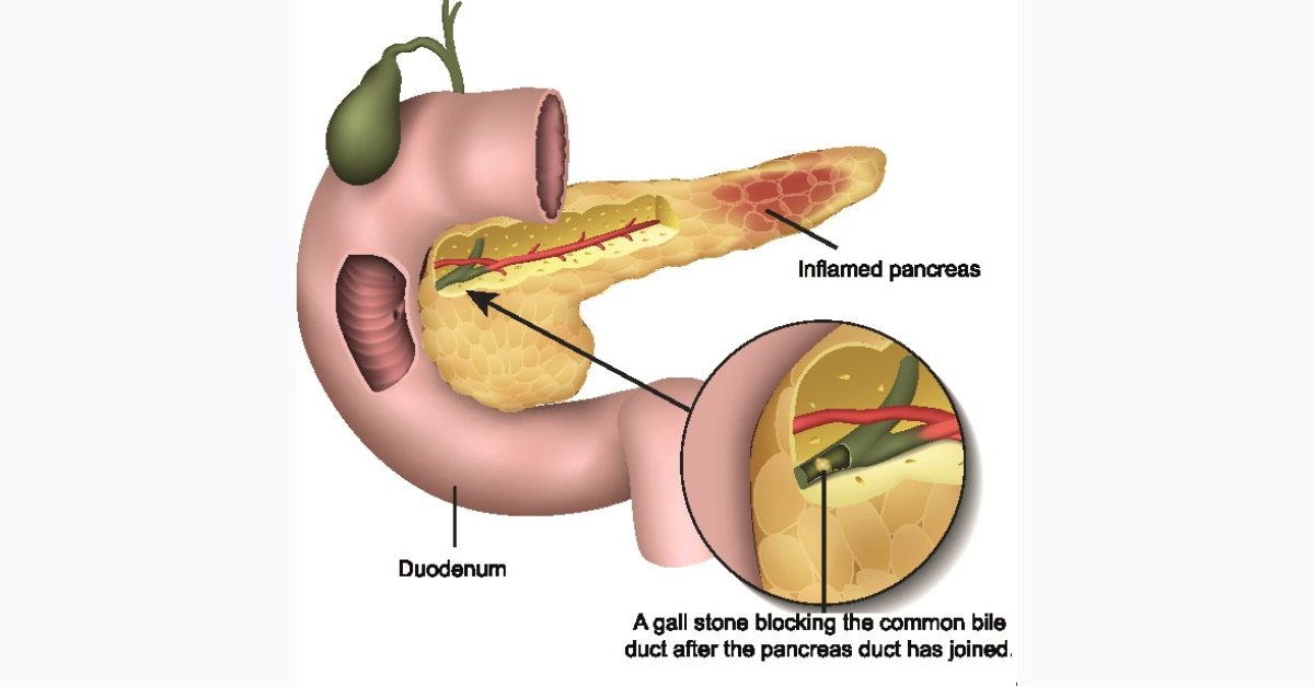 Pancreatitis  image