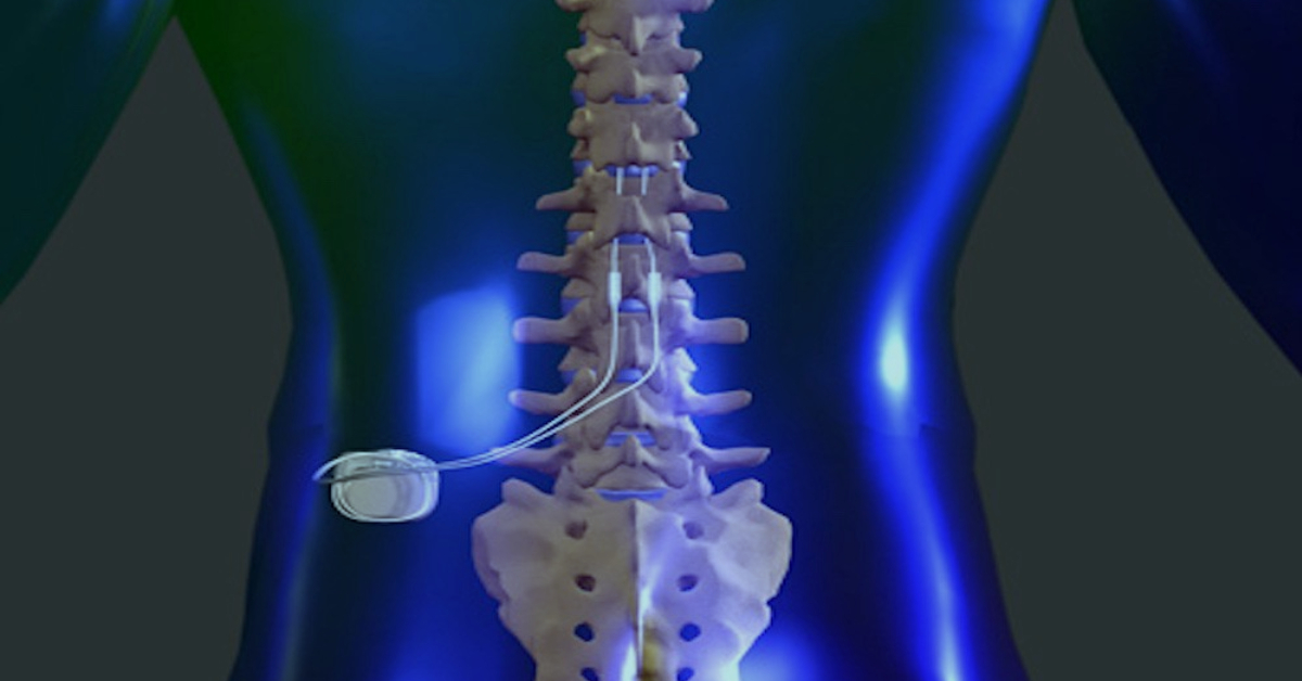 spinal cord stimulator