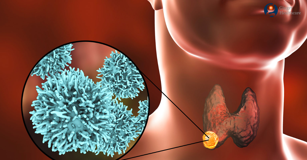 Can Papillary Thyroid Cancer Spread To Lungs