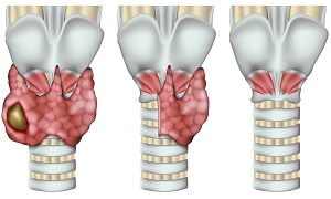 Thyroidectomy Image