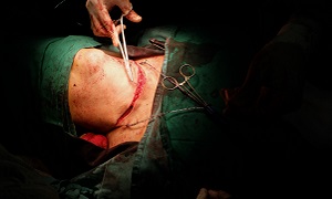 Thyroidectomy Surgery Image
