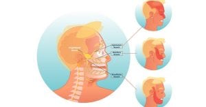 Trigeminal Neuralgia