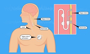 Vagus Nerve Stimuulation Image