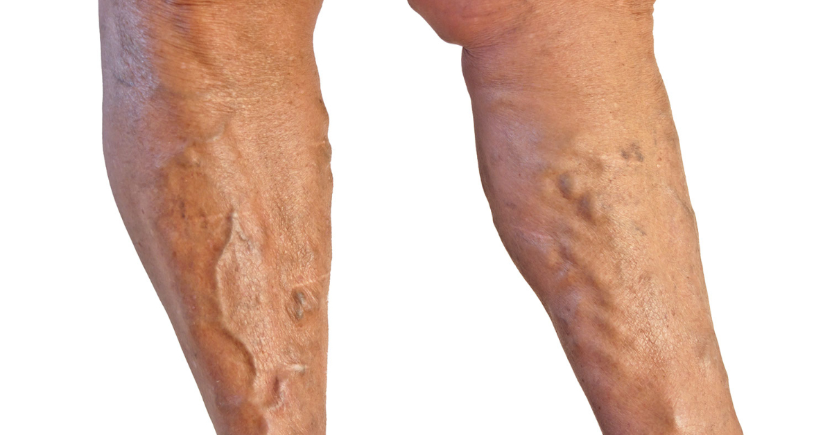 Cum de a trata remedii folic varicose - Artrită - Heel varikoz